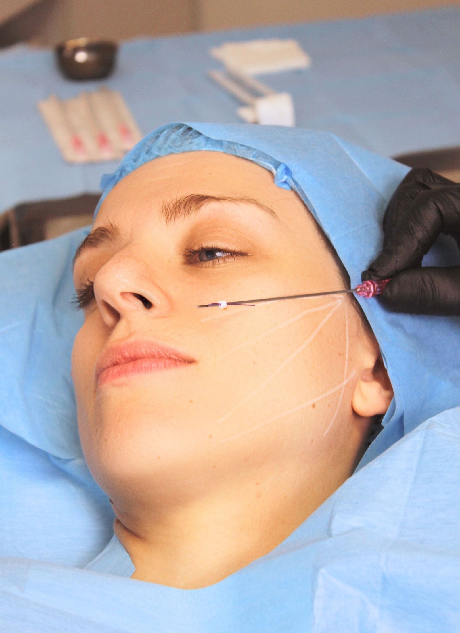 Fils tenseurs pour le visage